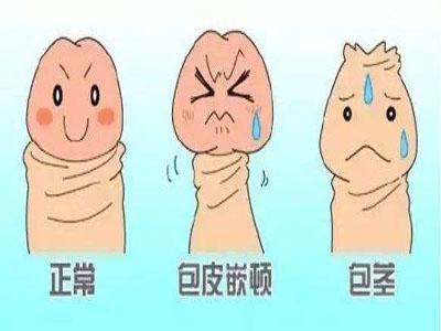 包皮过长症状,包皮过长表现,包皮过长病因,包皮过长预防,包皮过长检查,包皮过长危害