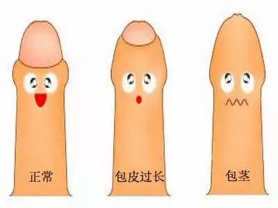 包茎手术费,包茎危害,包茎包皮,包茎治疗